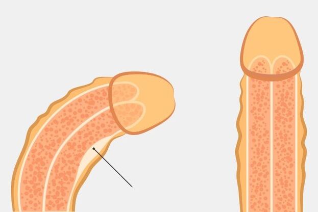 an effective way to erect the penis